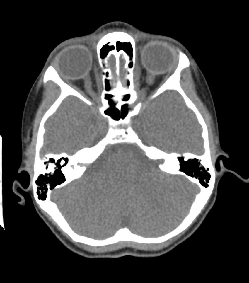 Nasoorbitoethmoid fracture (Radiopaedia 90044-107205 Axial non-contrast 165).jpg