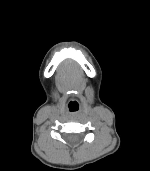 File:Nasoorbitoethmoid fracture (Radiopaedia 90044-107205 Axial non-contrast 38).jpg