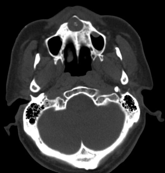 File:Nasopalatine duct cyst (Radiopaedia 11660-12023 Axial 1).jpg