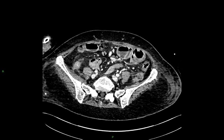 Neo-terminal ileal stricture (Crohn disease) (Radiopaedia 33790-34948 A 327).jpg