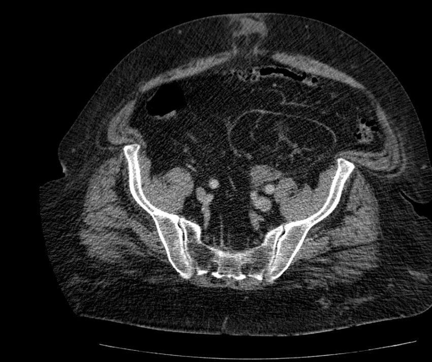 Nephroptosis with inguinal hernia containing perirenal fat (Radiopaedia 56632-63391 C 268).jpg