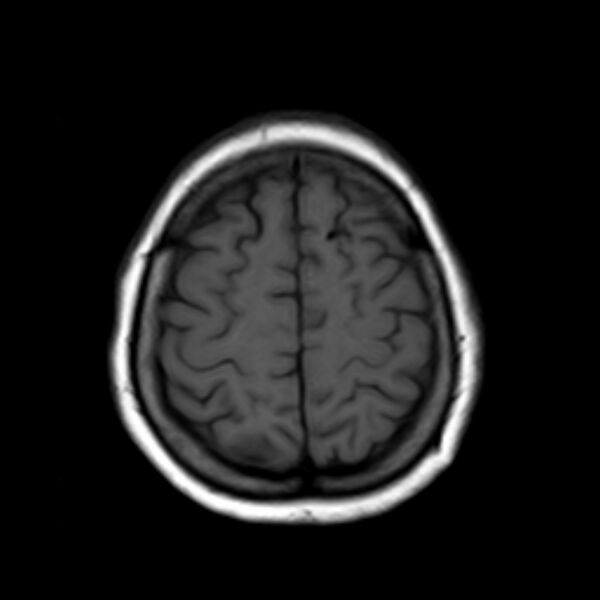 File:Neurofibromatosis type 2 (Radiopaedia 67470-76871 Axial T1 19).jpg