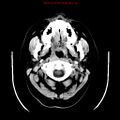 Neuroglial cyst (Radiopaedia 10713-11185 Axial non-contrast 32).jpg