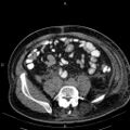Non Hodgkin lymphoma in a patient with ankylosing spondylitis (Radiopaedia 84323-99621 Axial non-contrast 46).jpg