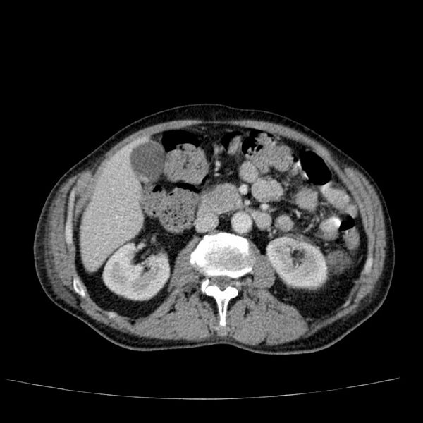 File:Non small-cell lung cancer (Radiopaedia 24467-24769 C+ delayed 75).jpg