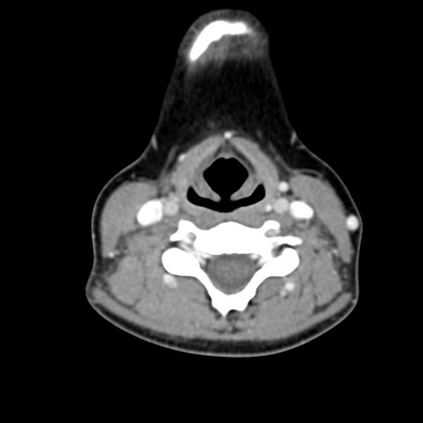 File:Normal CT of the neck (Radiopaedia 14575-14500 Axial C+ 42).jpg