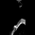 Normal CT of the neck (Radiopaedia 14575-14500 Sagittal C+ 51).jpg