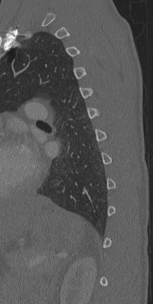 File:Normal CT thoracic spine (Radiopaedia 40181-42688 Sagittal bone window 10).png