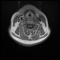 Normal cervical and thoracic spine MRI (Radiopaedia 35630-37156 Axial T1 C+ 18).png