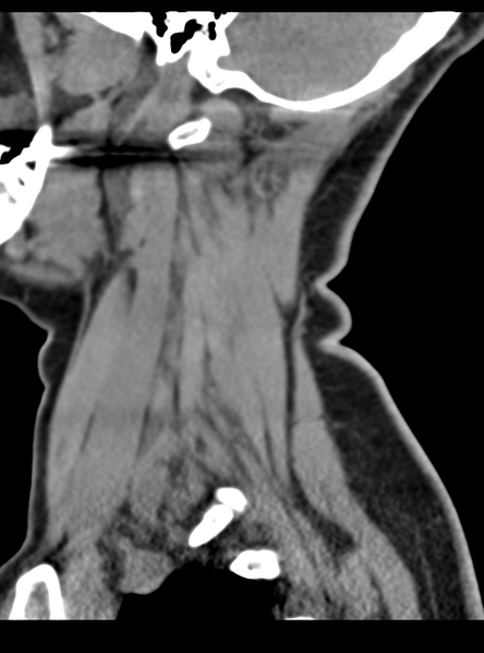File:Normal cervical spine MRI (including Dixon) (Radiopaedia 42762-45926 C 10).png