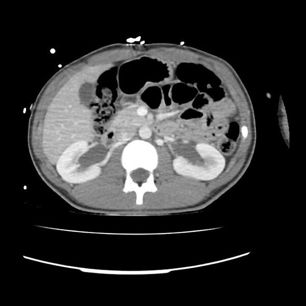 File:Normal dual-phase trauma CT chest,abdomen and pelvis (Radiopaedia 48092-52899 A 64).jpg