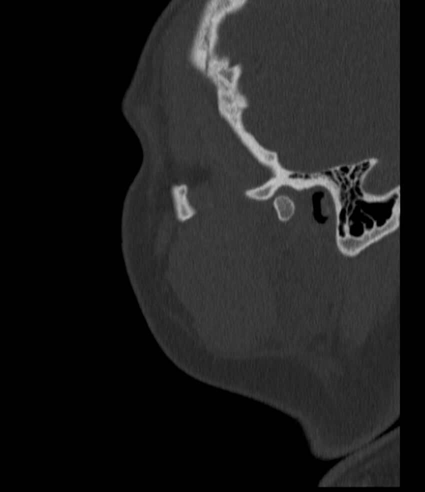 Normal facial bone CT (Radiopaedia 88742-105476 Sagittal bone window 28).jpg