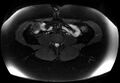 Normal liver MRI with Gadolinium (Radiopaedia 58913-66163 Axial T2 fat sat 1).jpg