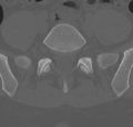 Normal lumbar spine CT (Radiopaedia 46533-50986 Axial bone window 63).png