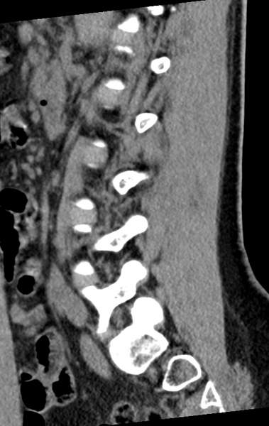 File:Normal lumbar spine CT (Radiopaedia 46533-50986 C 37).png