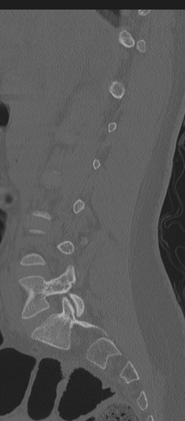 File:Normal lumbosacral CT (Radiopaedia 37923-39867 Sagittal bone window 64).png