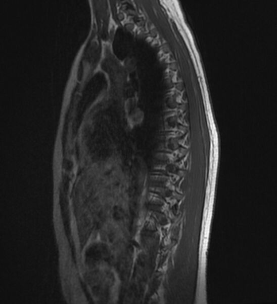 File:Normal thoracic spine MRI (Radiopaedia 41033-43781 Sagittal T1 3).jpg