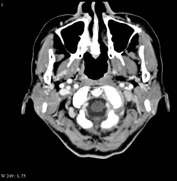 File:Occipital condyle metastasis - into mastoid (Radiopaedia 5424-7177 B 1).jpg