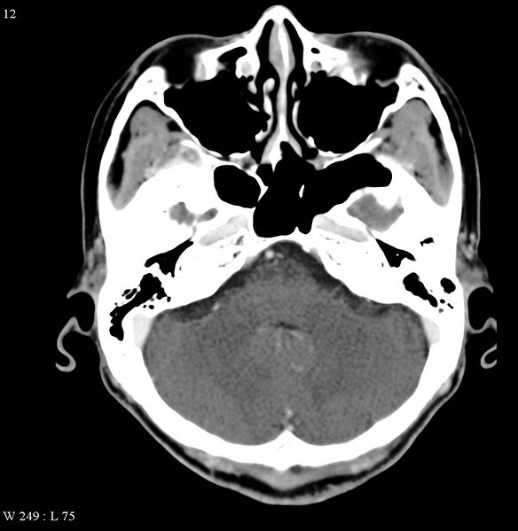 File:Occipital condyle metastasis - into mastoid (Radiopaedia 5424-7177 B 11).jpg