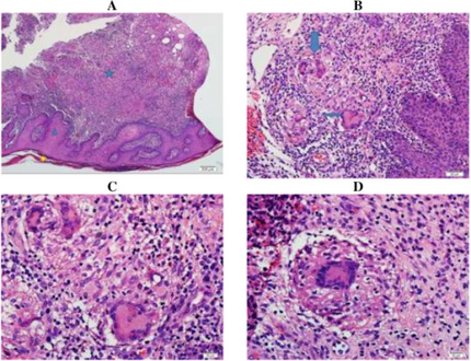 Histopathology-infant presenting with dermal necrotizing granulomatous giant cell reaction at the injection site of 13-valent pneumococcal conjugate vaccine