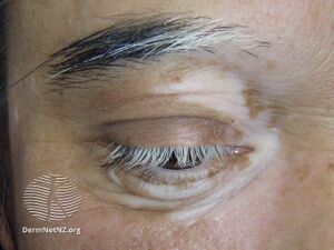 Poliosis (DermNet NZ hair-nails-sweat-poliosis3).jpg