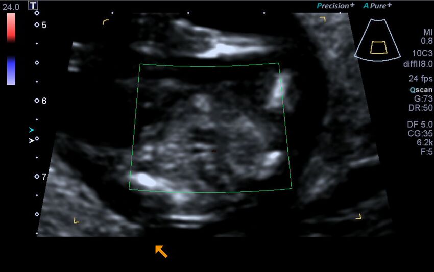 1st trimester nuchal-morphology ultrasound (Radiopaedia 44706-48477 Heart views cine with colour 195).jpg