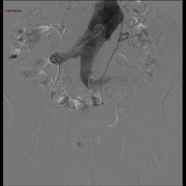 File:Abdominal aortic aneurysm (Radiopaedia 16155-15833 Frontal Aorta 3).jpg