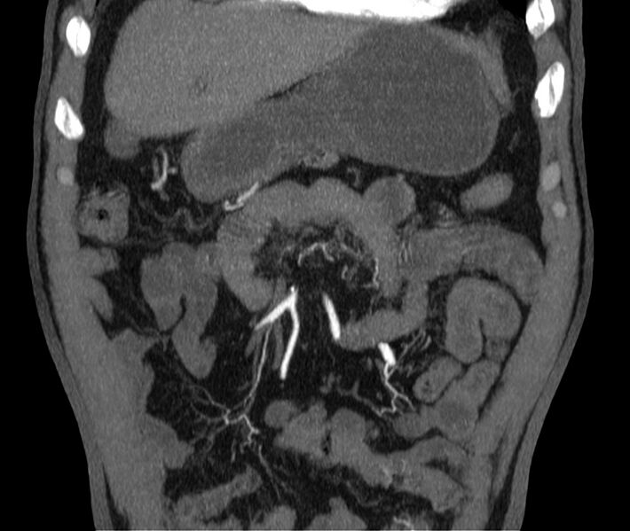 File:Abdominal aortic aneurysm (Radiopaedia 22421-22458 C 5).jpg