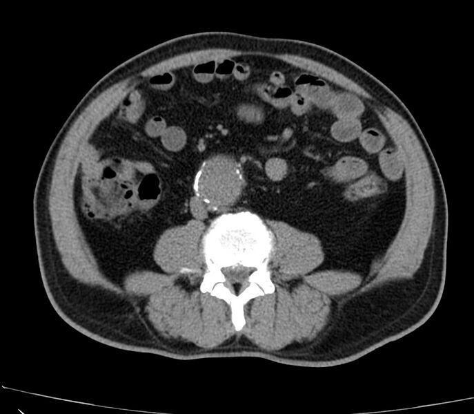 File:Abdominal aortic aneurysm (Radiopaedia 22421-22458 non-contrast 31).jpg