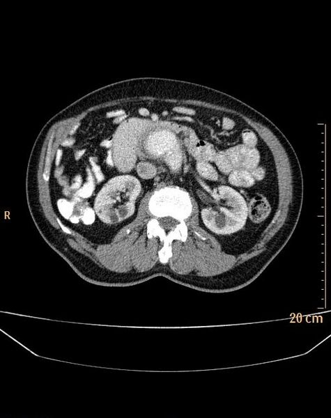 File:Abdominal aortic aneurysm (Radiopaedia 25985-26121 Axial C+ arterial phase 11).jpg