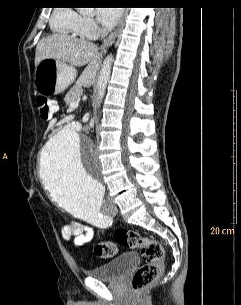 File:Abdominal aortic aneurysm (Radiopaedia 25985-26121 Sagittal C+ arterial phase 17).jpg
