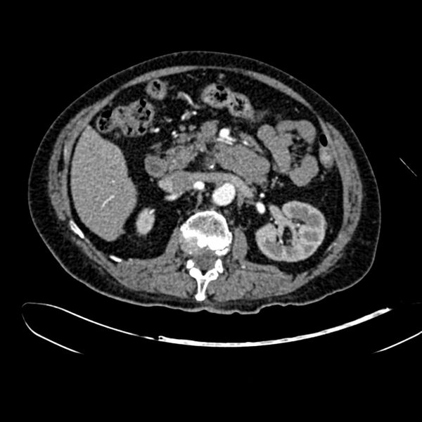 File:Abdominal aortic aneurysm (Radiopaedia 75131-86203 Axial C+ arterial phase 18).jpg