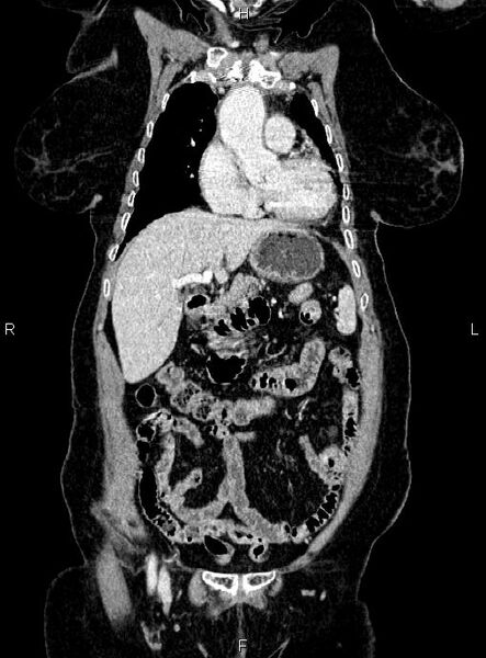 File:Abdominal aortic aneurysm (Radiopaedia 85063-100606 Coronal C+ arterial phase 14).jpg