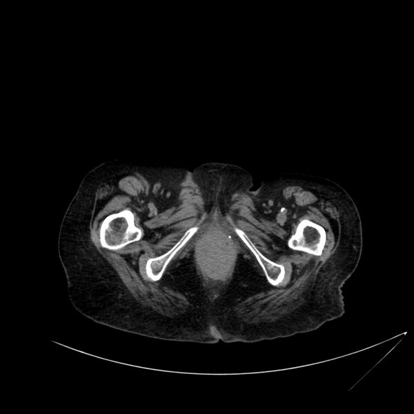 File:Abdominal aortic aneurysm - impending rupture (Radiopaedia 19233-19246 Axial non-contrast 135).jpg