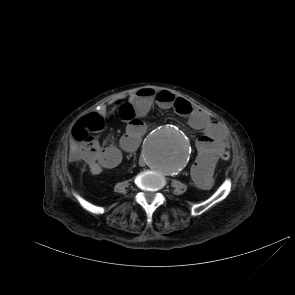 File:Abdominal aortic aneurysm - impending rupture (Radiopaedia 19233-19246 Axial non-contrast 77).jpg