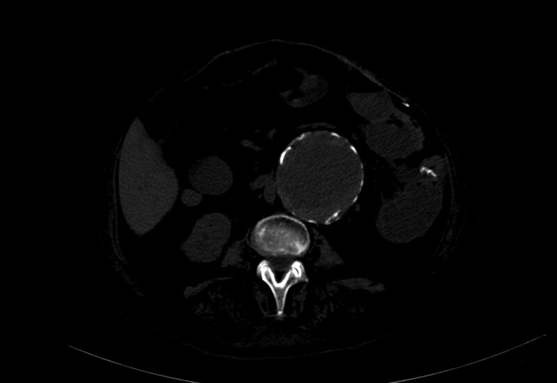 File:Abdominal aortic aneurysm - impending rupture (Radiopaedia 19233-19246 B 18).jpg
