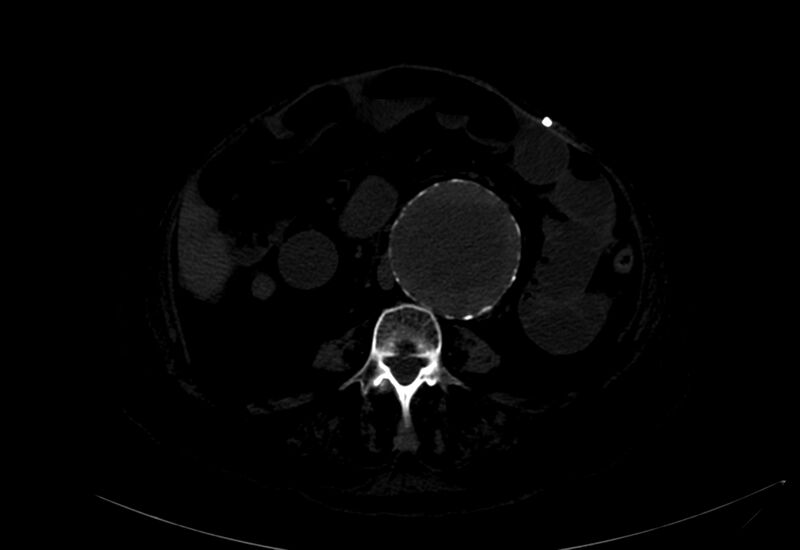 File:Abdominal aortic aneurysm - impending rupture (Radiopaedia 19233-19246 B 23).jpg