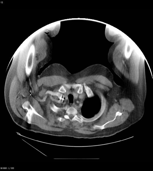 File:Abdominal aortic aneurysm with intramural hematoma then rupture (Radiopaedia 50278-55631 Axial C+ arterial phase 4).jpg