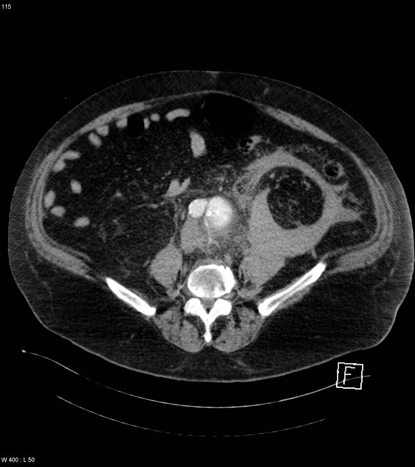 Abdominal aortic aneurysm with intramural hematoma then rupture (Radiopaedia 50278-55632 Axial C+ arterial phase 114).jpg