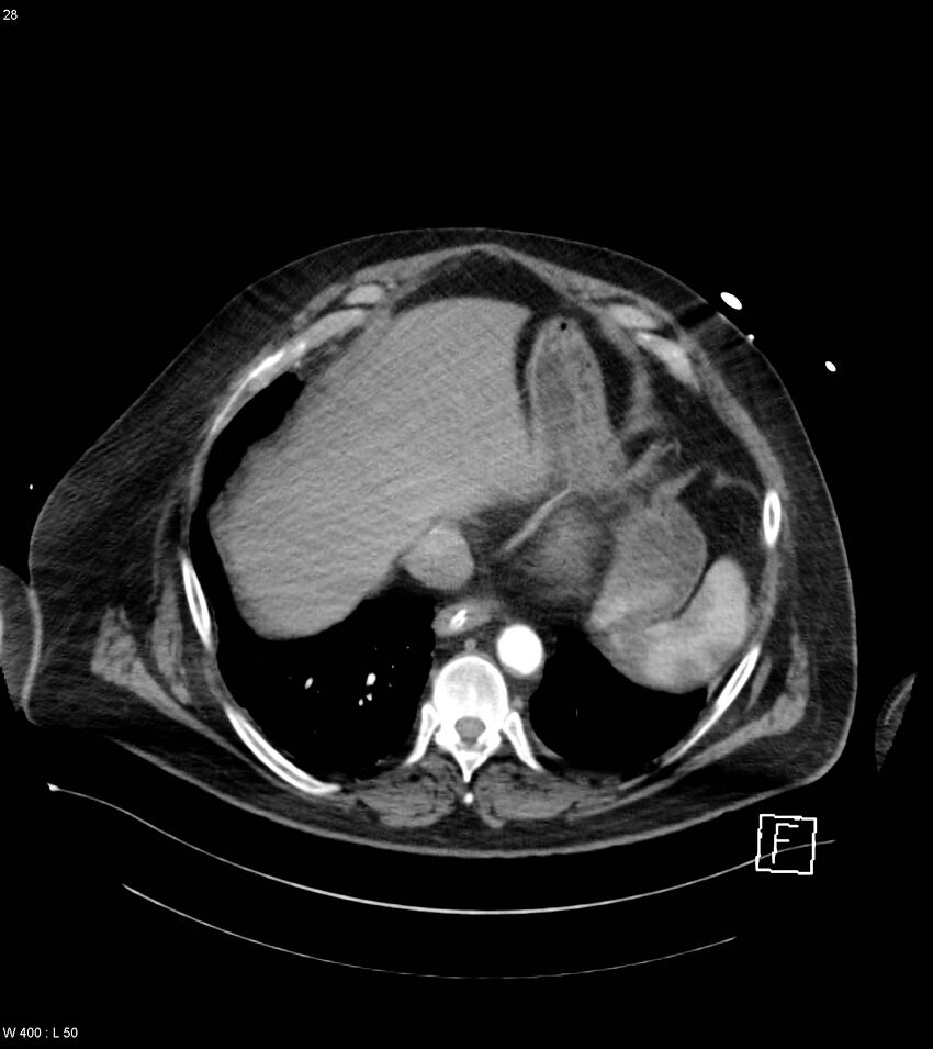 Abdominal aortic aneurysm with intramural hematoma then rupture (Radiopaedia 50278-55632 Axial C+ arterial phase 27).jpg