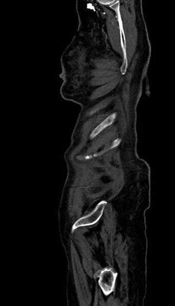 File:Abdominal aortic aneurysm with thrombus fissuration (Radiopaedia 73192-83919 Sagittal C+ arterial phase 1).jpg