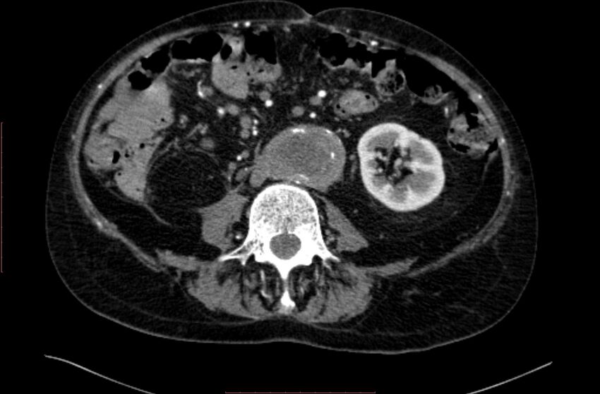 Abdominal aortic interposition tube graft and aneurysm thrombosis (Radiopaedia 71438-81857 Axial C+ arterial phase 96).jpg
