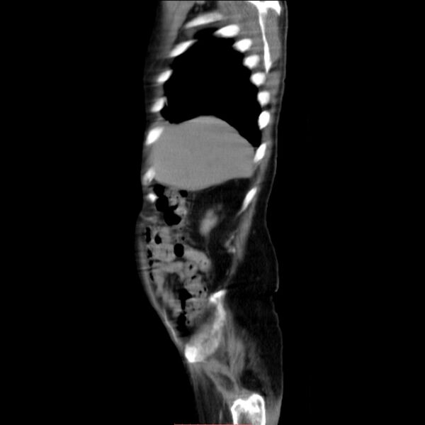 File:Abdominal aortic interposition tube graft and aneurysm thrombosis (Radiopaedia 71438-81857 Sagittal C+ arterial phase 30).jpg