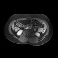 Abdominal wall endometriosis (Radiopaedia 83702-98847 Axial T1 C+ fat sat 5).jpg