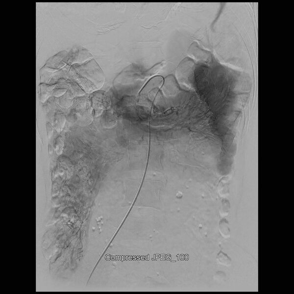 File:Abernethy malformation (Radiopaedia 42006-45462 Frontal Superior mesenteric artery 10).jpg