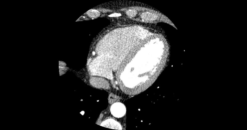 File:Aberrant left main coronary artery (ALMCA) arising from the right sinus with interarterial course (Radiopaedia 63251-71814 Axial C+ arterial phase 148).JPG