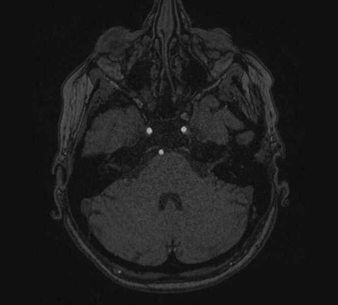 File:Accessory middle cerebral artery and ICA aneurysm (Radiopaedia 22656-22674 MRA 8).jpg