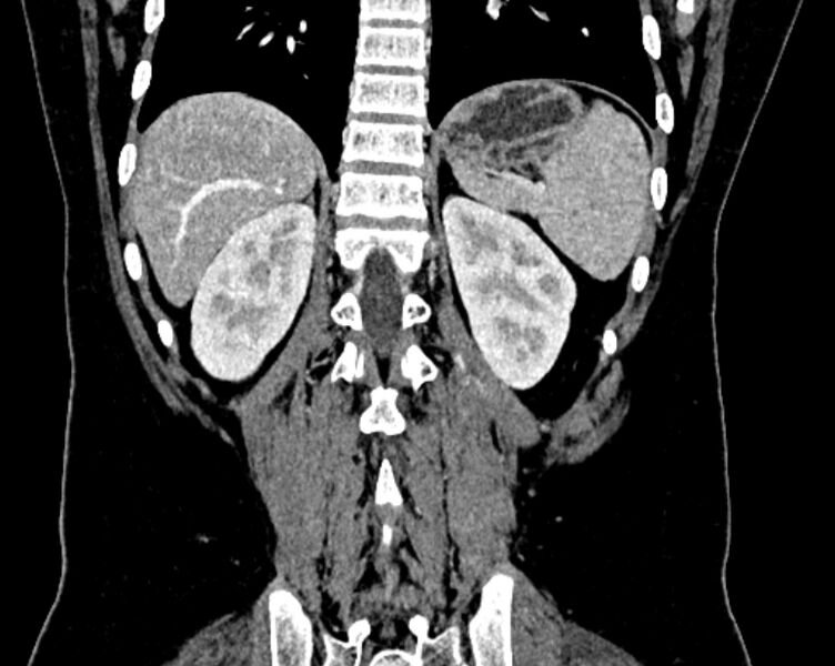 File:Accessory right inferior hepatic vein (Radiopaedia 75207-86305 Coronal C+ portal venous phase 60).jpg