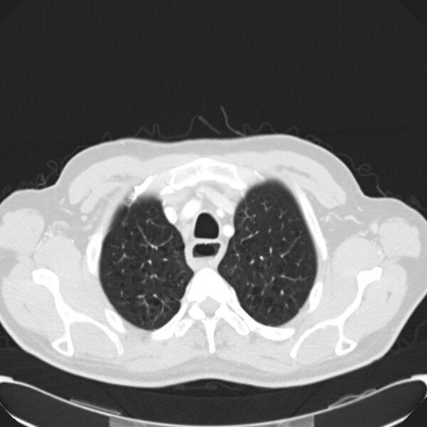 File:Achalasia (Radiopaedia 24937-25206 Axial lung window 5).jpg