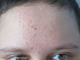 Acne due to systemic steroids